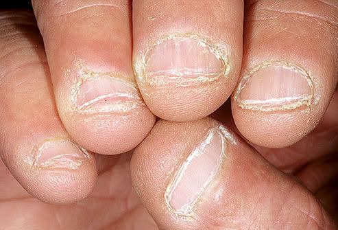 Nail biting or picking has also been linked to obsessive-compulsive disorder